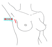 乳癌手術不留疤 『3D內視鏡微創』手術(相關圖片)