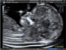 最新『4D彩色立體超音波儀器』	 腹胎檢查利器(相關圖片)