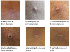 新公衛危機？  猴痘疫情介紹(相關圖片)