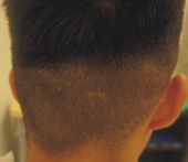 微創毛髮移植手術的小範圍應用   疤痕性禿髮及髮際線植髮(相關圖片)