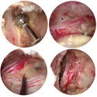 重新體會走路的樂趣 雙通道脊椎微創內視鏡椎管減壓手術(相關圖片)