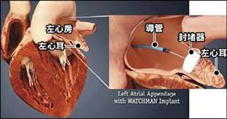 安全精準進行心臟介入手術的新武器  心臟內超音波(相關圖片)