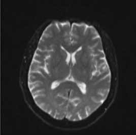 天氣冷颼颼容易誘發 缺血性腦中風 (相關圖片)