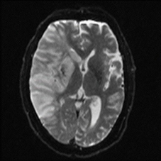 天氣冷颼颼容易誘發 缺血性腦中風 (相關圖片)