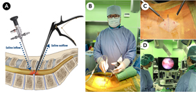 骨科部雙通道脊椎微創內視鏡手術技術再創巔峰(相關圖片)