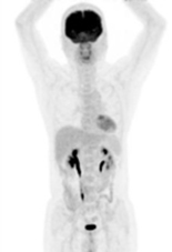 正子斷層掃描  在健康檢查所扮演的角色(相關圖片)