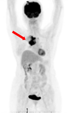 正子斷層掃描  在健康檢查所扮演的角色(相關圖片)