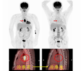 正子斷層掃描  在健康檢查所扮演的角色(相關圖片)