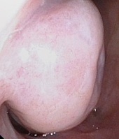 鼻子不舒服  是惱人的過敏性鼻炎嗎？(相關圖片)