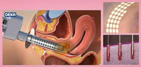 妳有婦女泌尿的困擾嗎？   有效改善尿失禁的「陰道雷射治療」(相關圖片)