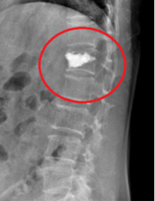 隱形殺手  骨質疏鬆與壓迫性骨折(相關圖片)