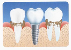 植牙  能一勞永逸嗎?(相關圖片)