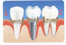 植牙  能一勞永逸嗎?(相關圖片)