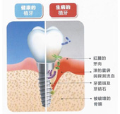 植牙  能一勞永逸嗎?(相關圖片)