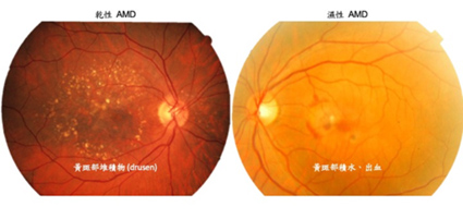 新藥新希望   老年性黃斑部病變的多元治療選擇(相關圖片)