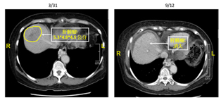 立體放射手術合併雷沙瓦 更有效增加肝癌病人存活的機會(相關圖片)