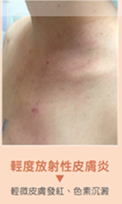 頭頸部癌病人  放射線治療期間遵循皮膚照護的重要性(相關圖片)