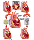 經導管主動脈瓣膜置換術 心臟病患者新選擇(相關圖片)