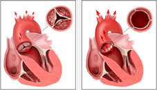 經導管主動脈瓣膜置換術 心臟病患者新選擇(相關圖片)