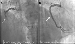 生和死一瞬間  談ST段上升心肌梗塞的治療(相關圖片)