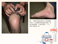 關節紅腫、熱痛診斷大不同  談陣發性風濕症(相關圖片)