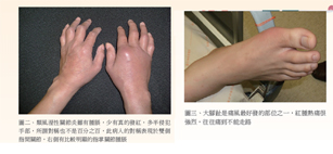 關節紅腫、熱痛診斷大不同  談陣發性風濕症(相關圖片)