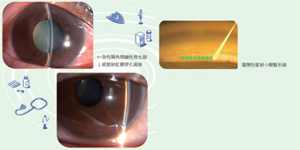 眼科常用雷射治療  談雷射後囊切開術及選擇性雷射小樑網整形術(相關圖片)