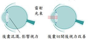 眼科常用雷射治療  談雷射後囊切開術及選擇性雷射小樑網整形術(相關圖片)