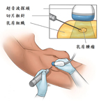 乳房攝影篩檢陽性  要怎麼辦？(相關圖片)