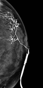 乳頭異常分泌物之診斷利器-乳管攝影(相關圖片)