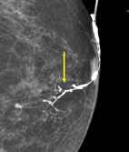 乳頭異常分泌物之診斷利器-乳管攝影(相關圖片)
