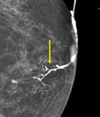 乳頭異常分泌物之診斷利器-乳管攝影(相關圖片)