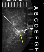 乳頭異常分泌物之診斷利器-乳管攝影(相關圖片)