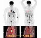 使用去氧葡萄糖全身正子掃描在診斷及治療癌症上的幫助(相關圖片)