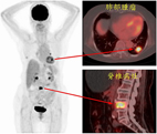 使用去氧葡萄糖全身正子掃描在診斷及治療癌症上的幫助(相關圖片)