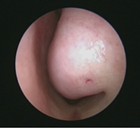 長年鼻塞好難呼吸怎麼辦  我是不是長鼻息肉?(相關圖片)