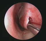 長年鼻塞好難呼吸怎麼辦  我是不是長鼻息肉?(相關圖片)