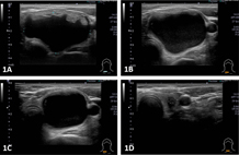頸部良性腫瘤  新式無疤痕超音波導引治療(相關圖片)