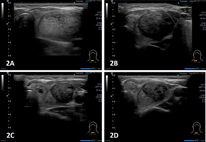 頸部良性腫瘤  新式無疤痕超音波導引治療(相關圖片)