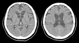 真的是失智嗎? 談常壓性水腦症的診斷與治療(相關圖片)