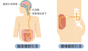 真的是失智嗎? 談常壓性水腦症的診斷與治療(相關圖片)