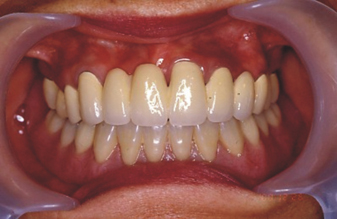 『植牙』 讓您美觀且笑口常開(相關圖片)