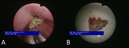 異物嗆入氣管 氣道異物引起的反覆肺炎與氣喘症狀(相關圖片)