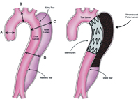 別讓主動脈剝離奪命  遠離危險因子就能保命(相關圖片)