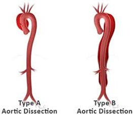 別讓主動脈剝離奪命  遠離危險因子就能保命(相關圖片)