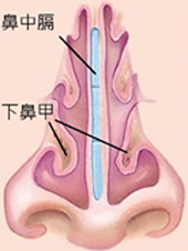 噴嚏打不完、鼻水流不停?   談過敏性鼻炎(相關圖片)
