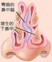 噴嚏打不完、鼻水流不停?   談過敏性鼻炎(相關圖片)