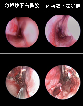 噴嚏打不完、鼻水流不停?   談過敏性鼻炎(相關圖片)