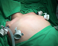 體表無疤痕已不再是夢  認識內視鏡甲狀腺切除手術(相關圖片)