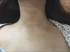 體表無疤痕已不再是夢  認識內視鏡甲狀腺切除手術(相關圖片)